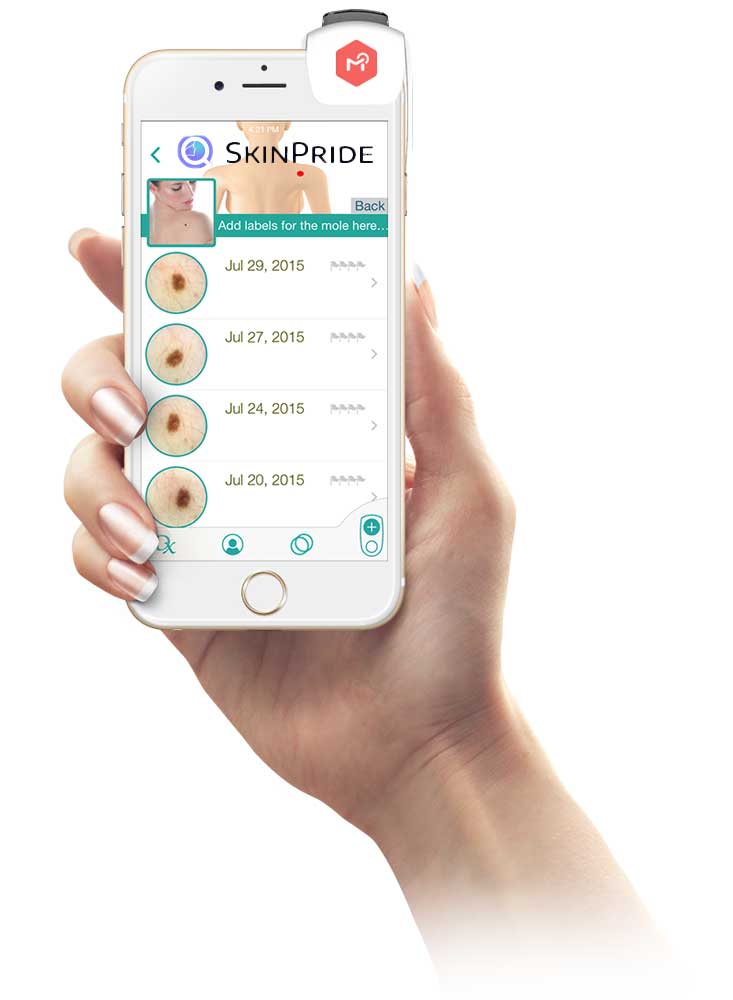 AI app for skin cancer
