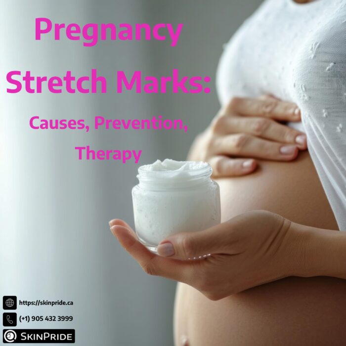 Pregnancy Stretch Marks